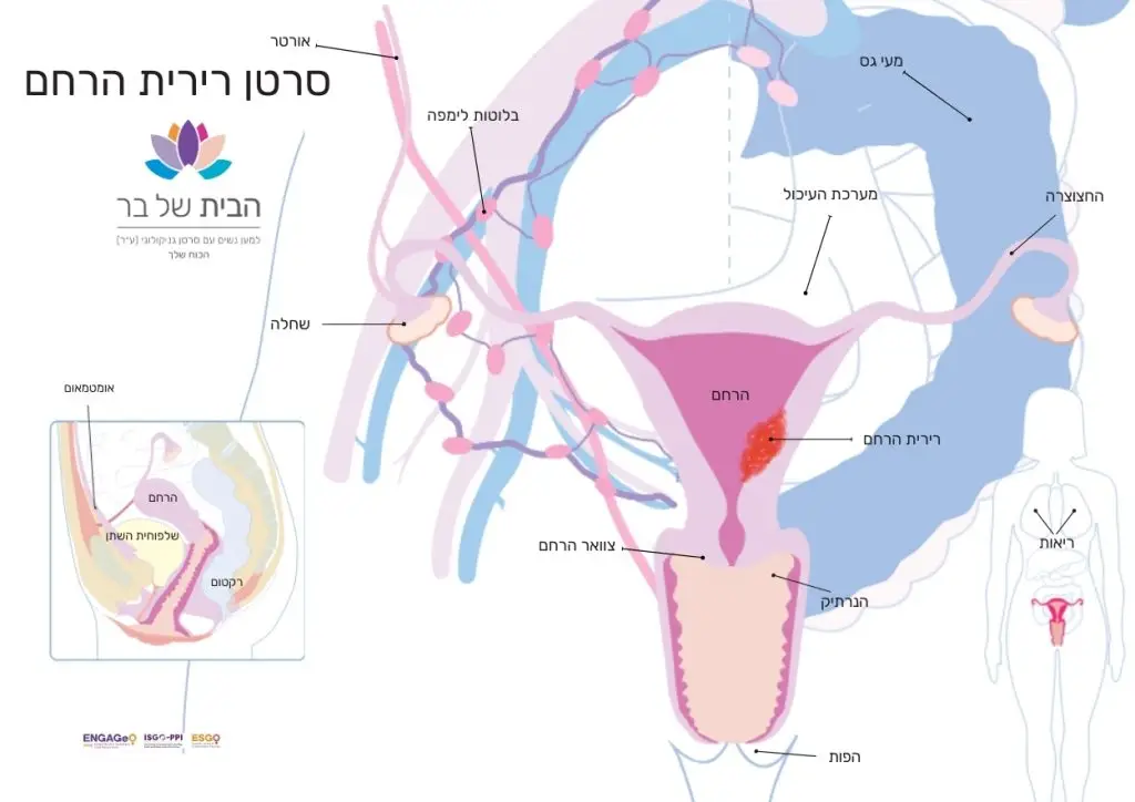 סרטן רירית הרחם